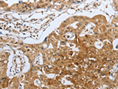 The image on the left is immunohistochemistry of paraffin-embedded Human lung cancer tissue using CASP12 Antibody(CASP12 Antibody) at dilution 1/50, on the right is treated with synthetic peptide. (Original magnification: ×200)