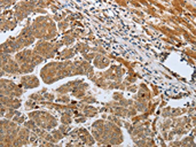 The image on the left is immunohistochemistry of paraffin-embedded Human liver cancer tissue using the antibody Antibody) at dilution 1/50, on the right is treated with synthetic peptide. (Original magnification: ×200)