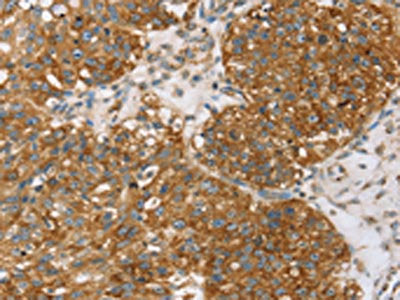 The image on the left is immunohistochemistry of paraffin-embedded Human breast cancer tissue using TPD52L2 Antibody(TPD52L2 Antibody) at dilution 1/35, on the right is treated with synthetic peptide. (Original magnification: ×200)Rabbit anti-Human TPD52L2 Polyclonal Antibody