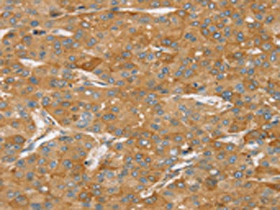 The image on the left is immunohistochemistry of paraffin-embedded Human liver cancer tissue using the antibody Antibody) at dilution 1/35, on the right is treated with synthetic peptide. (Original magnification: ×200)Rabbit anti-Human TPD52L2 Polyclonal Antibody