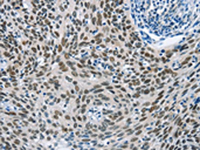 The image on the left is immunohistochemistry of paraffin-embedded Human cervical cancer tissue using GTF2I Antibody(GTF2I Antibody) at dilution 1/40, on the right is treated with synthetic peptide. (Original magnification: ×200)Rabbit anti-Human GTF2I Polyclonal Antibody
