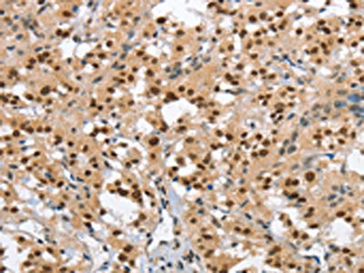 The image on the left is immunohistochemistry of paraffin-embedded Human thyroid cancer tissue using the antibody Antibody) at dilution 1/40, on the right is treated with synthetic peptide. (Original magnification: ×200)Rabbit anti-Human GTF2I Polyclonal Antibody