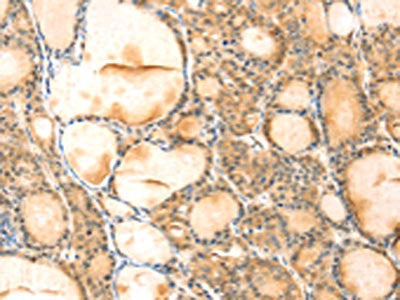 The image on the left is immunohistochemistry of paraffin-embedded Human thyroid cancer tissue using VMP1 Antibody(VMP1 Antibody) at dilution 1/35, on the right is treated with synthetic peptide. (Original magnification: ×200)Rabbit anti-Human VMP1 Polyclonal Antibody