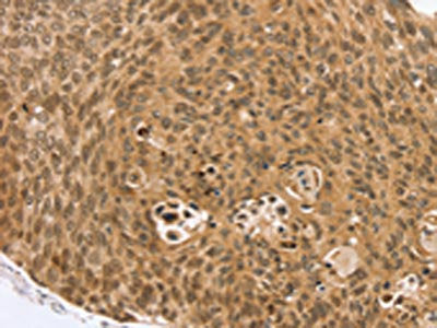 The image on the left is immunohistochemistry of paraffin-embedded Human esophagus cancer tissue using the antibody Antibody) at dilution 1/35, on the right is treated with synthetic peptide. (Original magnification: ×200)Rabbit anti-Human VMP1 Polyclonal Antibody