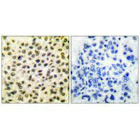 Immunohistochemical analysis of paraffin-embedded human breast carcinoma tissue using Fos antibody.Rabbit anti-Human FOS Polyclonal Antibody