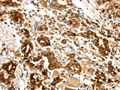 The image on the left is immunohistochemistry of paraffin-embedded Human gastic cancer tissue using LYZ Antibody(LYZ Antibody) at dilution 1/20, on the right is treated with fusion protein. (Original magnification: ×200)