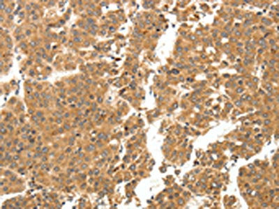 The image on the left is immunohistochemistry of paraffin-embedded Human breast cancer tissue using the antibody Antibody) at dilution 1/20, on the right is treated with fusion protein. (Original magnification: ×200)