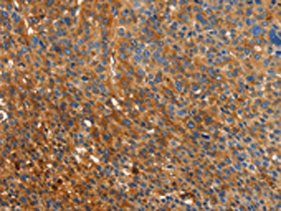 The image on the left is immunohistochemistry of paraffin-embedded Human liver cancer tissue using ORM2 Antibody(ORM2 Antibody) at dilution 1/40, on the right is treated with fusion protein. (Original magnification: ×200)Rabbit anti-Human ORM2 Polyclonal Antibody