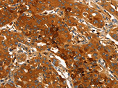 The image on the left is immunohistochemistry of paraffin-embedded Human lung cancer tissue using the antibody Antibody) at dilution 1/40, on the right is treated with fusion protein. (Original magnification: ×200)Rabbit anti-Human ORM2 Polyclonal Antibody