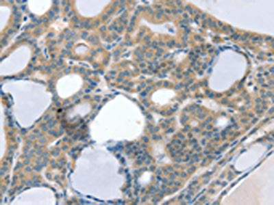The image on the left is immunohistochemistry of paraffin-embedded Human thyroid cancer tissue using CCS Antibody(CCS Antibody) at dilution 1/30, on the right is treated with synthetic peptide. (Original magnification: ×200)Rabbit anti-Human CCS Polyclonal Antibody