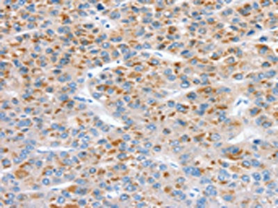 The image on the left is immunohistochemistry of paraffin-embedded Human liver cancer tissue using the antibody Antibody) at dilution 1/30, on the right is treated with synthetic peptide. (Original magnification: ×200)Rabbit anti-Human CCS Polyclonal Antibody