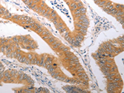The image on the left is immunohistochemistry of paraffin-embedded Human colon cancer tissue using PPAP2C Antibody(PPAP2C Antibody) at dilution 1/40, on the right is treated with synthetic peptide. (Original magnification: ×200)Rabbit anti-Human PPAP2C Polyclonal Antibody