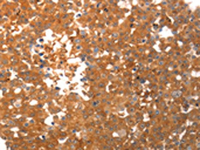 The image on the left is immunohistochemistry of paraffin-embedded Human breast cancer tissue using the antibody Antibody) at dilution 1/40, on the right is treated with synthetic peptide. (Original magnification: ×200)Rabbit anti-Human PPAP2C Polyclonal Antibody