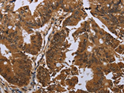 The image on the left is immunohistochemistry of paraffin-embedded Human colon cancer tissue using GJB4 Antibody(GJB4 Antibody) at dilution 1/50, on the right is treated with synthetic peptide. (Original magnification: ×200)Rabbit anti-Human GJB4 Polyclonal Antibody