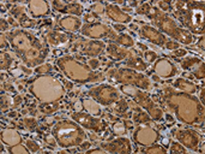 The image on the left is immunohistochemistry of paraffin-embedded Human thyroid cancer tissue using the antibody Antibody) at dilution 1/50, on the right is treated with synthetic peptide. (Original magnification: ×200)Rabbit anti-Human GJB4 Polyclonal Antibody