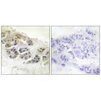 Immunohistochemistry analysis of paraffin-embedded human breast carcinoma tissue using Mammaglobin antibody.Rabbit anti-Human SCGB2A2 Polyclonal Antibody