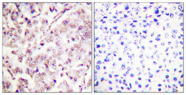 Immunohistochemical analysis of paraffin-embedded human breast carcinoma tissue, using ETS1 (Phospho-Thr38) antibody (left)or the same antibody preincubated with blocking peptide (right).Rabbit anti-Mus musculus (Mouse) Ets1 Polyclonal Antibody