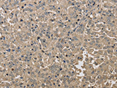 The image on the left is immunohistochemistry of paraffin-embedded Human liver cancer tissue using KDM5B Antibody(KDM5B Antibody) at dilution 1/40, on the right is treated with synthetic peptide. (Original magnification: ×200)
