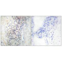 Immunohistochemistry analysis of paraffin-embedded human prostate carcinoma tissue using LRAT antibody.