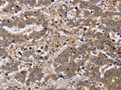 The image on the left is immunohistochemistry of paraffin-embedded Human liver cancer tissue using FHL1 Antibody(FHL1 Antibody) at dilution 1/20, on the right is treated with fusion protein. (Original magnification: ×200)Rabbit anti-Human FHL1 Polyclonal Antibody