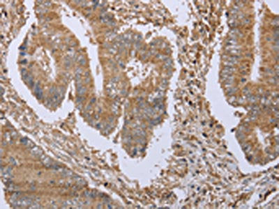 The image on the left is immunohistochemistry of paraffin-embedded Human colon cancer tissue using the antibody Antibody) at dilution 1/20, on the right is treated with fusion protein. (Original magnification: ×200)Rabbit anti-Human FHL1 Polyclonal Antibody