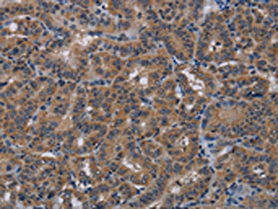 The image on the left is immunohistochemistry of paraffin-embedded Human thyroid cancer tissue using the antibody Antibody) at dilution 1/40, on the right is treated with synthetic peptide. (Original magnification: ×200)Rabbit anti-Human PDE4A Polyclonal Antibody