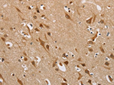 The image on the left is immunohistochemistry of paraffin-embedded Human brain  tissue using DDX43 Antibody(DDX43 Antibody) at dilution 1/40, on the right is treated with fusion protein. (Original magnification: ×200)Rabbit anti-Human DDX43 Polyclonal Antibody