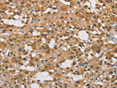 The image on the left is immunohistochemistry of paraffin-embedded Human thyroid cancer tissue using the antibody Antibody) at dilution 1/40, on the right is treated with fusion protein. (Original magnification: ×200)Rabbit anti-Human DDX43 Polyclonal Antibody