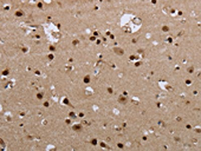The image on the left is immunohistochemistry of paraffin-embedded Human brain  tissue using GCKR Antibody(GCKR Antibody) at dilution 1/50, on the right is treated with fusion protein. (Original magnification: ×200)Rabbit anti-Human GCKR Polyclonal Antibody