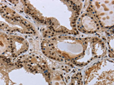 The image on the left is immunohistochemistry of paraffin-embedded Human colon cancer tissue using the antibody Antibody) at dilution 1/50, on the right is treated with fusion protein. (Original magnification: ×200)Rabbit anti-Human GCKR Polyclonal Antibody