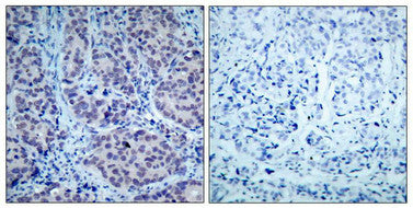 Immunohistochemical analysis of paraffin-embedded human breast carcinoma tissue using HDAC2(Ab-394) Antibody(left) or the same antibody preincubated with blocking peptide(right).Rabbit anti-Human HDAC2 Polyclonal Antibody
