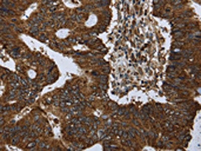 The image on the left is immunohistochemistry of paraffin-embedded Human colon cancer tissue using the antibody Antibody) at dilution 1/30, on the right is treated with synthetic peptide. (Original magnification: ×200)Rabbit anti-Human PPP1R13L Polyclonal Antibody