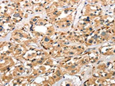 The image on the left is immunohistochemistry of paraffin-embedded Human thyroid cancer tissue using CTSE Antibody(CTSE Antibody) at dilution 1/40, on the right is treated with fusion protein. (Original magnification: ×200)Rabbit anti-Human CTSE Polyclonal Antibody