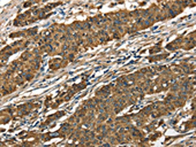 The image on the left is immunohistochemistry of paraffin-embedded Human gastic cancer tissue using the antibody Antibody) at dilution 1/40, on the right is treated with fusion protein. (Original magnification: ×200)Rabbit anti-Human CTSE Polyclonal Antibody