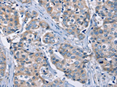 The image on the left is immunohistochemistry of paraffin-embedded Human breast cancer tissue using KCNQ5 Antibody(KCNQ5 Antibody) at dilution 1/30, on the right is treated with fusion protein. (Original magnification: ×200)