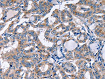 The image on the left is immunohistochemistry of paraffin-embedded Human thyroid cancer tissue using the antibody Antibody) at dilution 1/30, on the right is treated with fusion protein. (Original magnification: ×200)