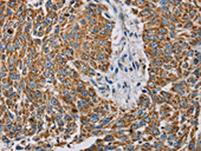 The image on the left is immunohistochemistry of paraffin-embedded Human lung cancer tissue using MTFP1 Antibody(MTFP1 Antibody) at dilution 1/30, on the right is treated with fusion protein. (Original magnification: ×200)Rabbit anti-Human MTFP1 Polyclonal Antibody