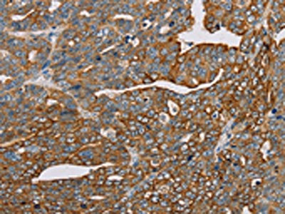 The image on the left is immunohistochemistry of paraffin-embedded Human cervical cancer tissue using the antibody Antibody) at dilution 1/30, on the right is treated with fusion protein. (Original magnification: ×200)Rabbit anti-Human MTFP1 Polyclonal Antibody