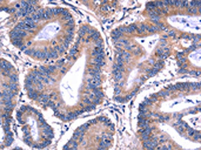 The image on the left is immunohistochemistry of paraffin-embedded Human colon cancer tissue using PVR Antibody(PVR Antibody) at dilution 1/20, on the right is treated with fusion protein. (Original magnification: ×200)Rabbit anti-Human PVR Polyclonal Antibody