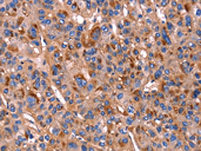 The image on the left is immunohistochemistry of paraffin-embedded Human liver cancer tissue using the antibody Antibody) at dilution 1/20, on the right is treated with fusion protein. (Original magnification: ×200)Rabbit anti-Human PVR Polyclonal Antibody