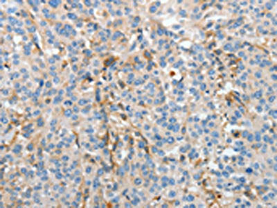 The image on the left is immunohistochemistry of paraffin-embedded Human esophagus cancer tissue using APOH Antibody(APOH Antibody) at dilution 1/30, on the right is treated with fusion protein. (Original magnification: ×200)Rabbit anti-Human APOH Polyclonal Antibody