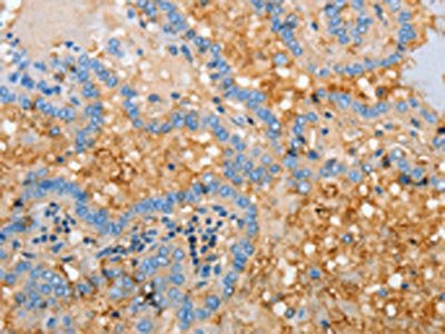 The image on the left is immunohistochemistry of paraffin-embedded Human thyroid cancer tissue using the antibody Antibody) at dilution 1/30, on the right is treated with fusion protein. (Original magnification: ×200)Rabbit anti-Human APOH Polyclonal Antibody