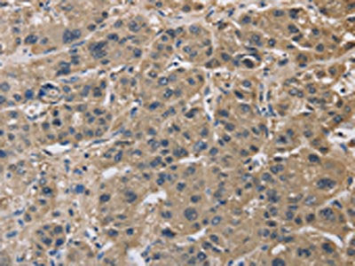 The image on the left is immunohistochemistry of paraffin-embedded Human liver cancer tissue using IMPDH1 Antibody(IMPDH1 Antibody) at dilution 1/20, on the right is treated with synthetic peptide. (Original magnification: ×200)Rabbit anti-Human IMPDH1 Polyclonal Antibody