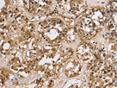 The image on the left is immunohistochemistry of paraffin-embedded Human thyroid cancer tissue using the antibody Antibody) at dilution 1/20, on the right is treated with synthetic peptide. (Original magnification: ×200)Rabbit anti-Human IMPDH1 Polyclonal Antibody