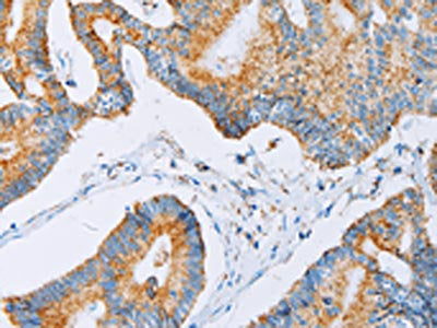 The image on the left is immunohistochemistry of paraffin-embedded Human colon cancer tissue using the antibody Antibody) at dilution 1/30, on the right is treated with fusion protein. (Original magnification: ×200)