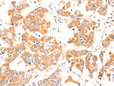 The image on the left is immunohistochemistry of paraffin-embedded Human breast cancer tissue using PRDX2 Antibody(PRDX2 Antibody) at dilution 1/80, on the right is treated with synthetic peptide. (Original magnification: ×200)Rabbit anti-Human PRDX2 Polyclonal Antibody