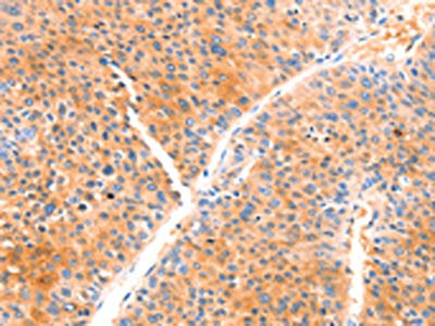 The image on the left is immunohistochemistry of paraffin-embedded Human liver cancer tissue using the antibody Antibody) at dilution 1/80, on the right is treated with synthetic peptide. (Original magnification: ×200)Rabbit anti-Human PRDX2 Polyclonal Antibody