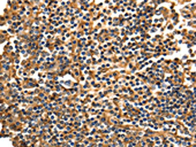 The image on the left is immunohistochemistry of paraffin-embedded Human tonsil tissue using ANXA5 Antibody(ANXA5 Antibody) at dilution 1/40, on the right is treated with fusion protein. (Original magnification: ×200)Rabbit anti-Human ANXA5 Polyclonal Antibody