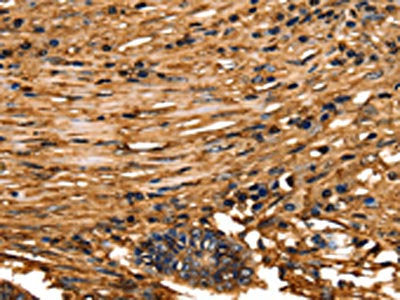 The image on the left is immunohistochemistry of paraffin-embedded Human colon cancer tissue using the antibody Antibody) at dilution 1/40, on the right is treated with fusion protein. (Original magnification: ×200)Rabbit anti-Human ANXA5 Polyclonal Antibody