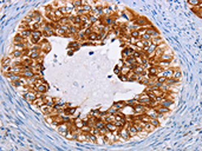 The image on the left is immunohistochemistry of paraffin-embedded Human cervical cancer tissue using KRT13 Antibody(KRT13 Antibody) at dilution 1/35, on the right is treated with fusion protein. (Original magnification: ×200)